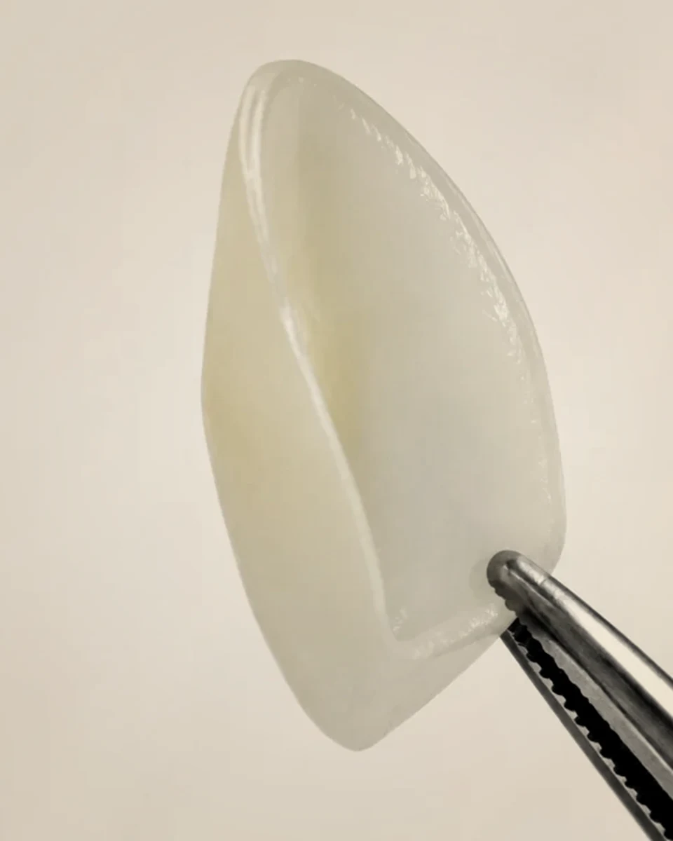 Thin porcelain veneer shell, AI-generated product illustration