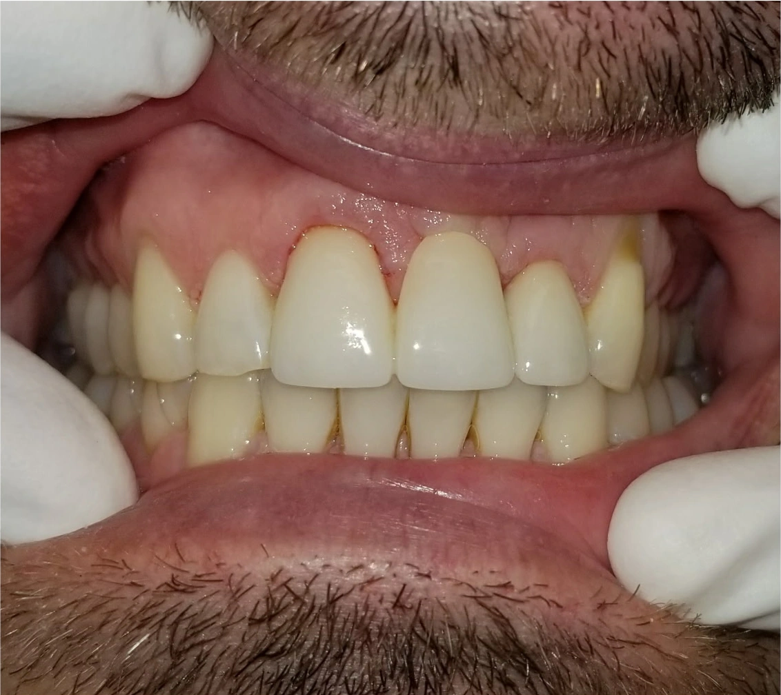 Patient's teeth after care at Pearl Dental Care