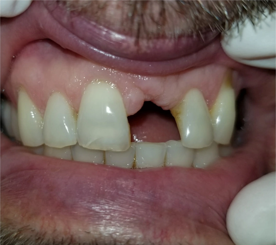 Patient's teeth before care at Pearl Dental Care